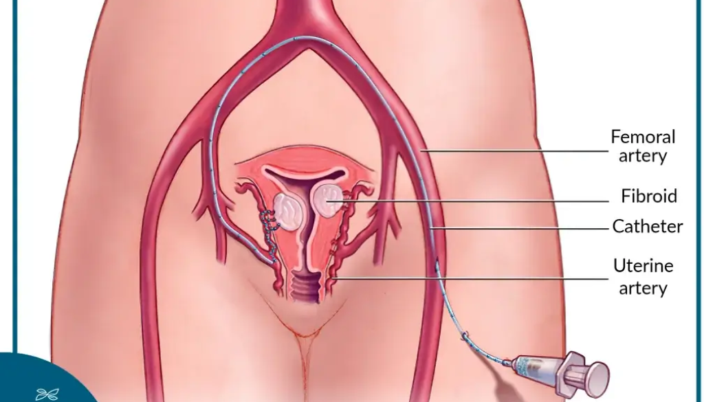 Interventional Radiology Techniques for Treating Uterine Fibroids