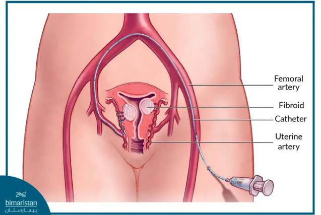 Interventional Radiology Techniques for Treating Uterine Fibroids