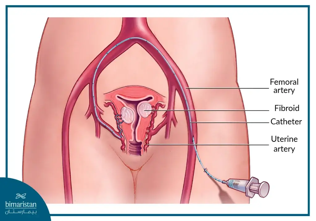 Interventional Radiology Techniques for Treating Uterine Fibroids
