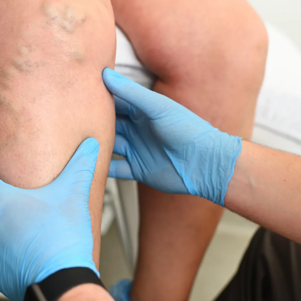 The Connection Between Spider Veins and Overall Venous Health