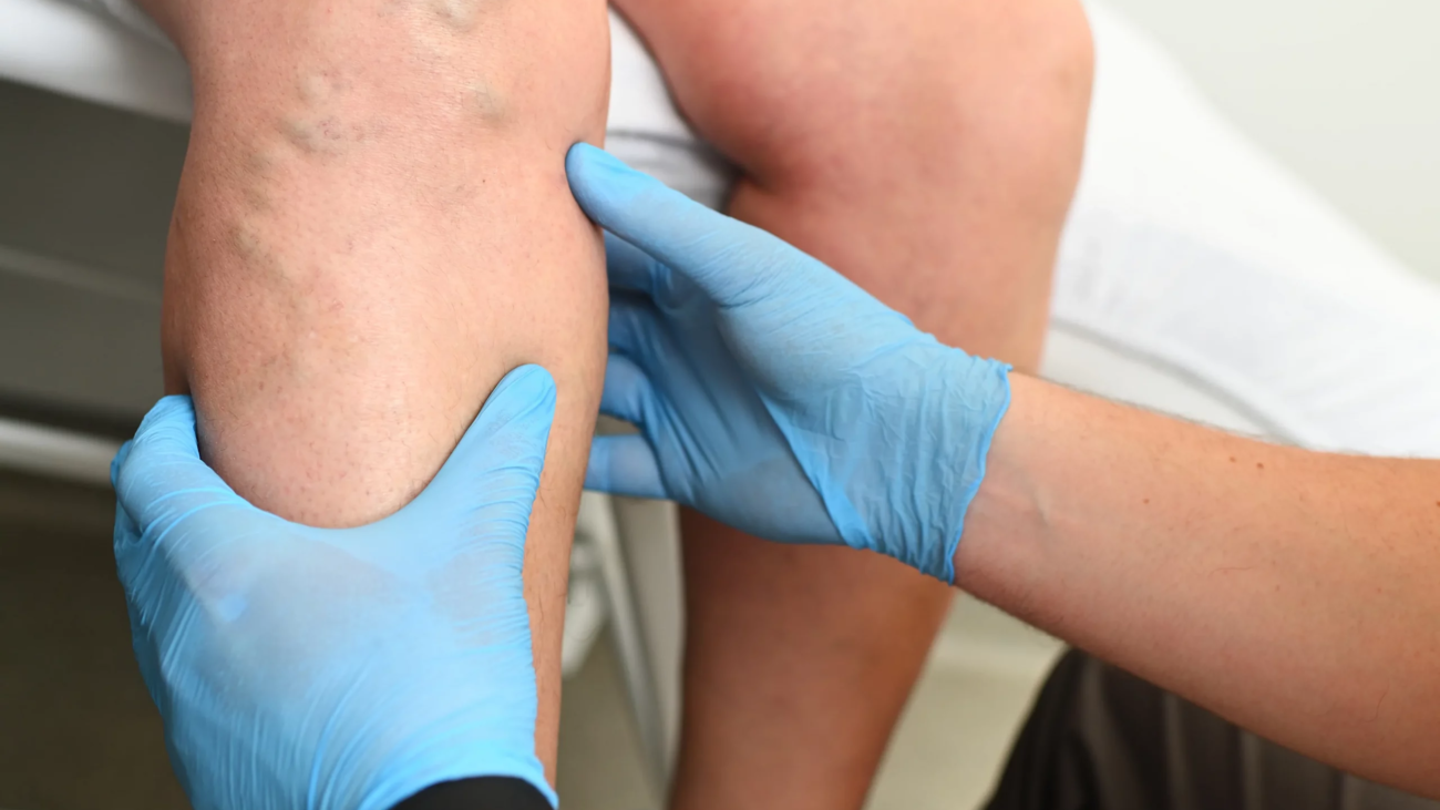The Connection Between Spider Veins and Overall Venous Health