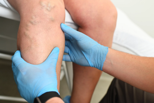 The Connection Between Spider Veins and Overall Venous Health