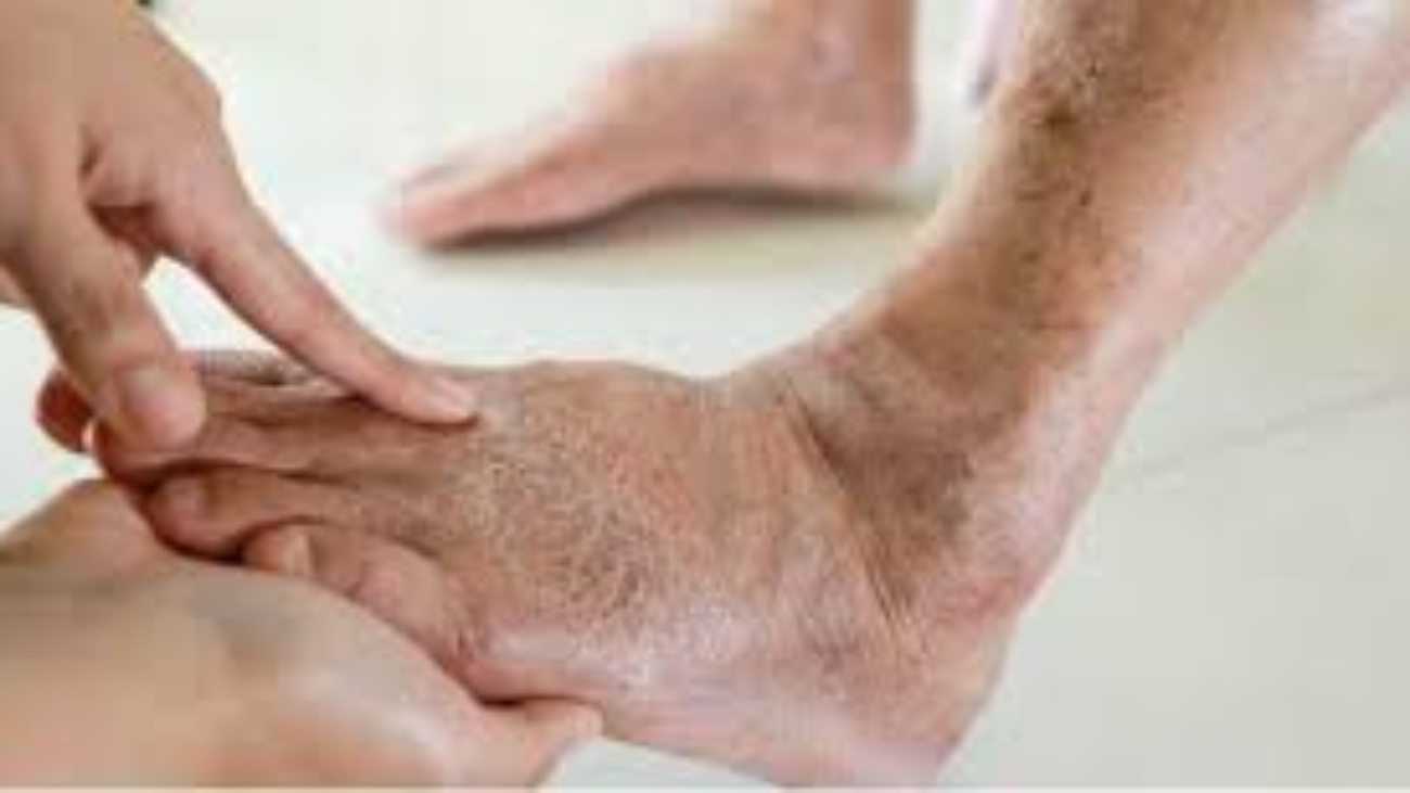 Understanding the Connection Between Varicose Veins and Obesity