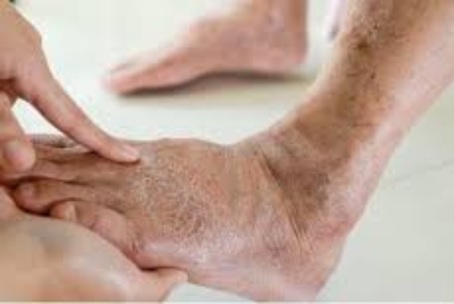 Understanding the Connection Between Varicose Veins and Obesity