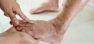 Understanding the Connection Between Varicose Veins and Obesity